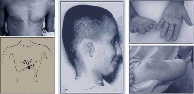 marcas-de-nacimiento